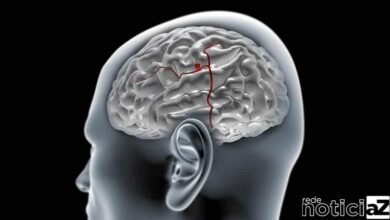 Aneurisma cerebral: por que a doença mata antes de ser diagnosticada?