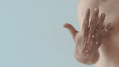 Brasil atinge a marca de 10 mil casos da varíola do macaco