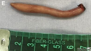 Bebê nasce com uma cauda de 6 centímetros