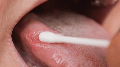 Leucoplasia: Manchas brancas na mucosa da boca devem ser investigadas