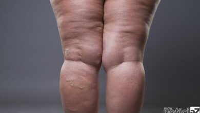 Conheça os 10 sinais para identificar a Lipedema