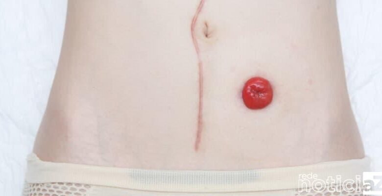 Entenda sobre o procedimento ostomia que o ator Luciano Szafir passou