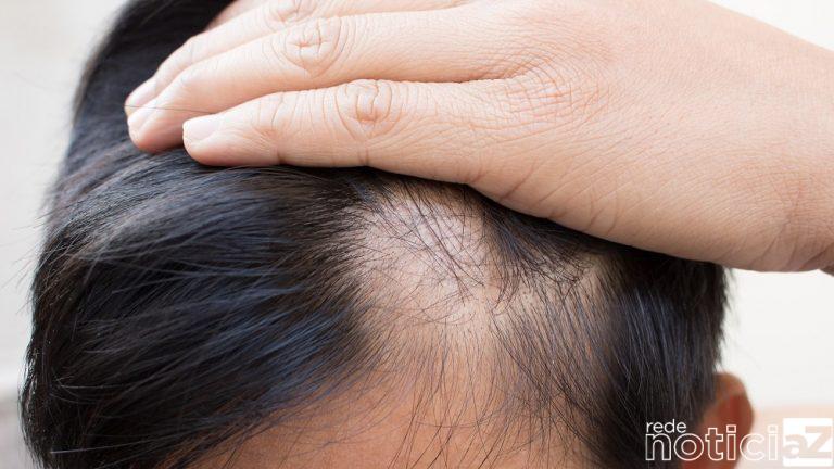 Alopecia: Além de doença física, um mal para a autoestima