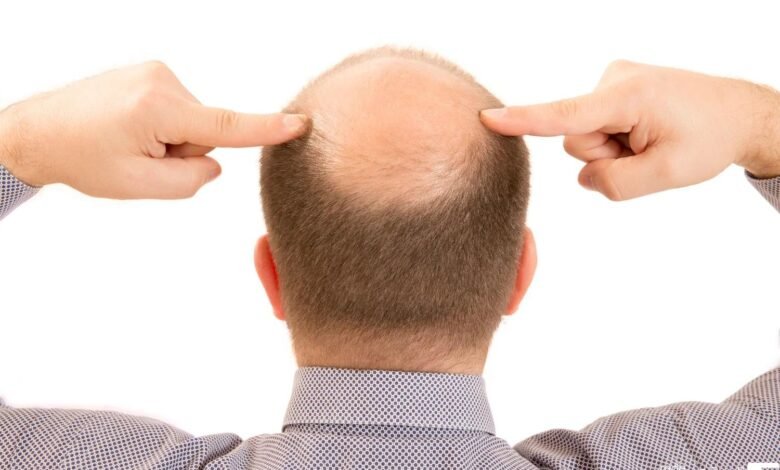 De oito a cada dez homens são portadores do gene da alopecia androgenética de padrão masculino