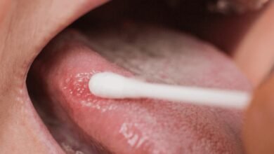 Leucoplasia: Manchas brancas na mucosa da boca devem ser investigadas