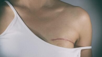 Vai fazer cirurgia de mama? Conheça os riscos e orientações para a correção