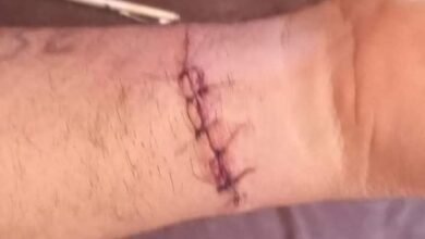 Jovem é ferido por linha com Cerol