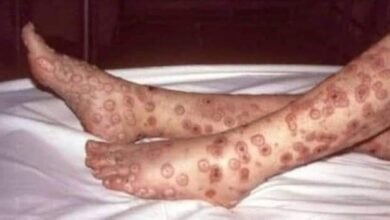 Primeiro caso confirmado de varíola dos macacos em Sertãozinho-SP