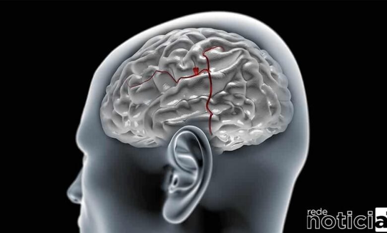 Aneurisma cerebral: por que a doença mata antes de ser diagnosticada?