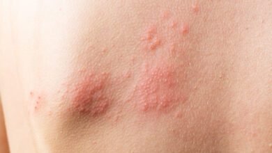 Barretos tem cinco casos suspeitos de varíola do macaco