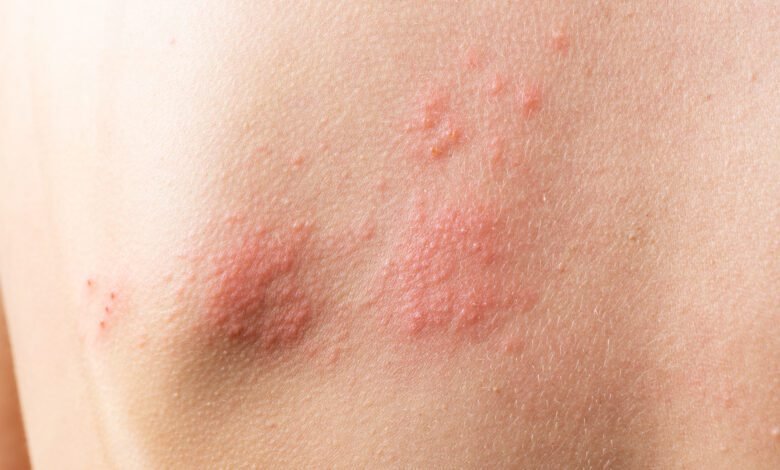 Barretos tem cinco casos suspeitos de varíola do macaco