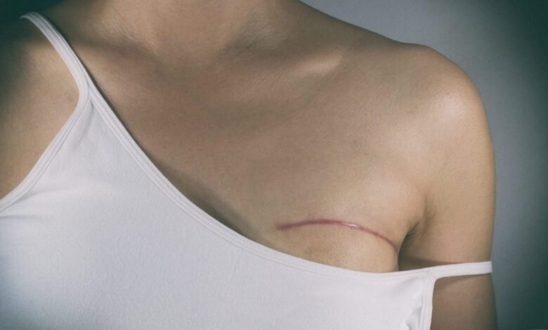 Vai fazer cirurgia de mama? Conheça os riscos e orientações para a correção