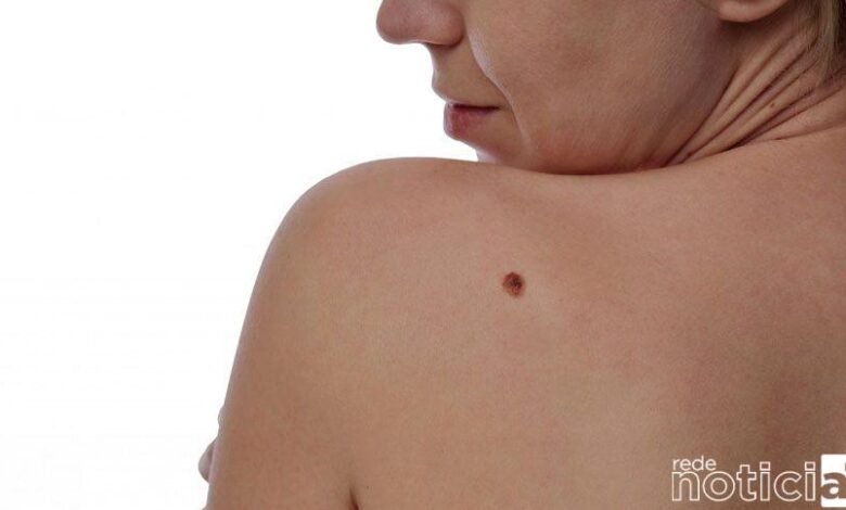 Melanoma é responsável pelos casos de câncer de pele