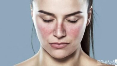 Lúpus: doença autoimune é a mais grave