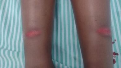 Menina de 6 anos tem pernas cortadas por linha de cerol em Colômbia