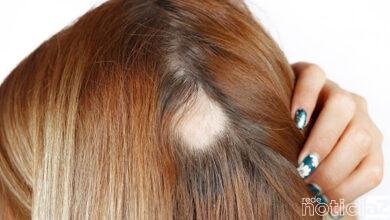 A calvície feminina incomoda e pode ter diversas causas. Segundo a Associação Brasileira de Cirurgia da Restauração Capilar, desde 2004, o número