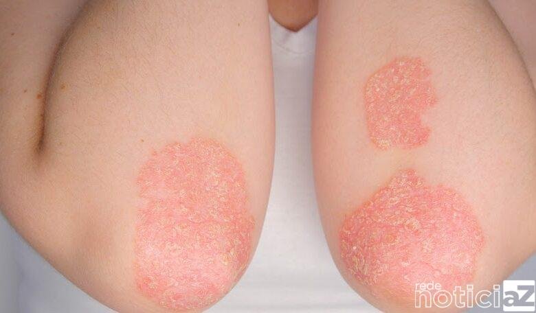 Mutirão gratuito de psoríase será realizado em Jundiaí