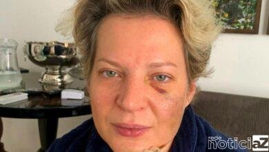 Quem quebrou a cara da deputada Joice Hasselmann?