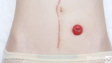 Entenda sobre o procedimento ostomia que o ator Luciano Szafir passou