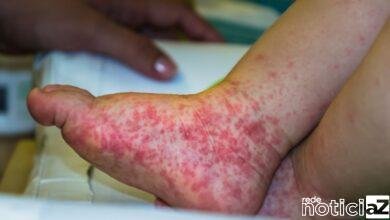 Síndrome 'Mão-Pé-Boca' gera alerta em Jundiaí