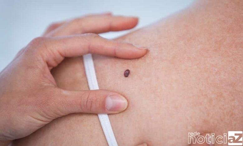 Dezembro Laranja é mês de alerta ao câncer de pele