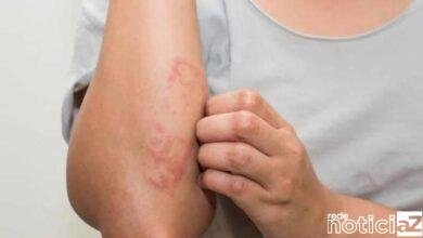 Janeiro é o mês para alertar contra a hanseníase