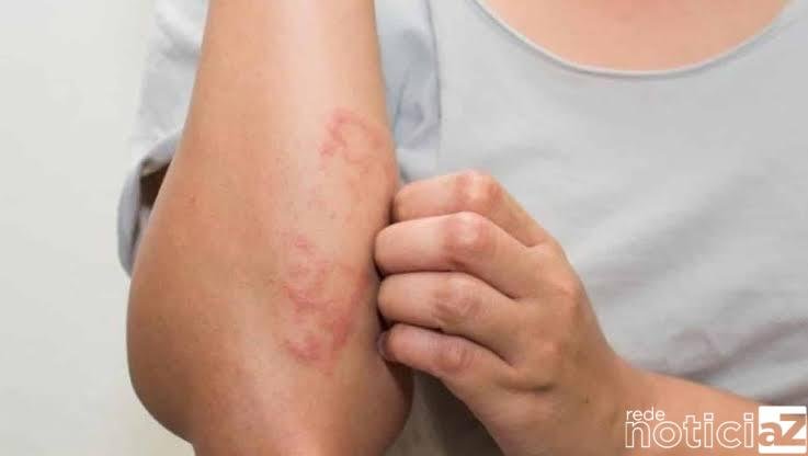 Janeiro é o mês para alertar contra a hanseníase