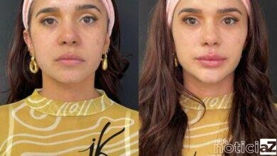 A harmonização facial tem grande busca por famosos