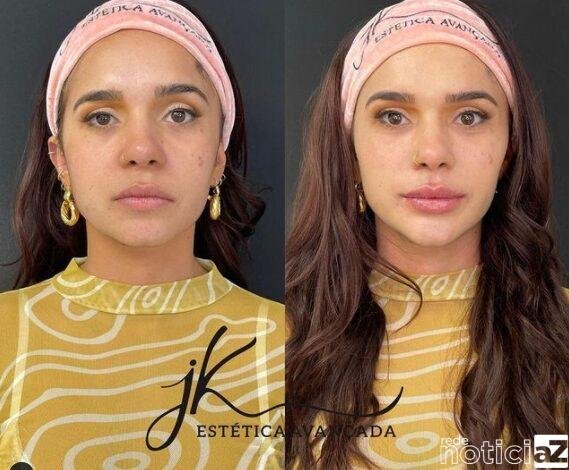 A harmonização facial tem grande busca por famosos