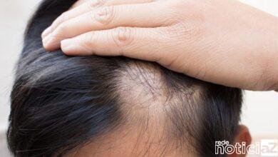 Alopecia: Além de doença física, um mal para a autoestima