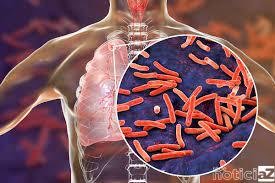 tuberculose