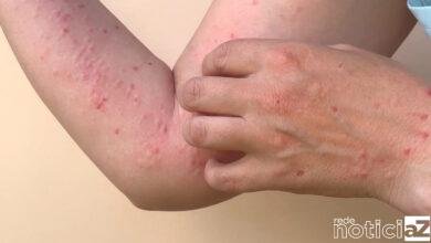 Primeira morte por varíola dos macacos no Brasil é confirmada