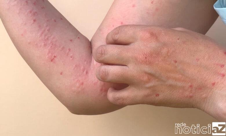 Primeira morte por varíola dos macacos no Brasil é confirmada