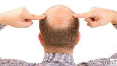 De oito a cada dez homens são portadores do gene da alopecia androgenética de padrão masculino