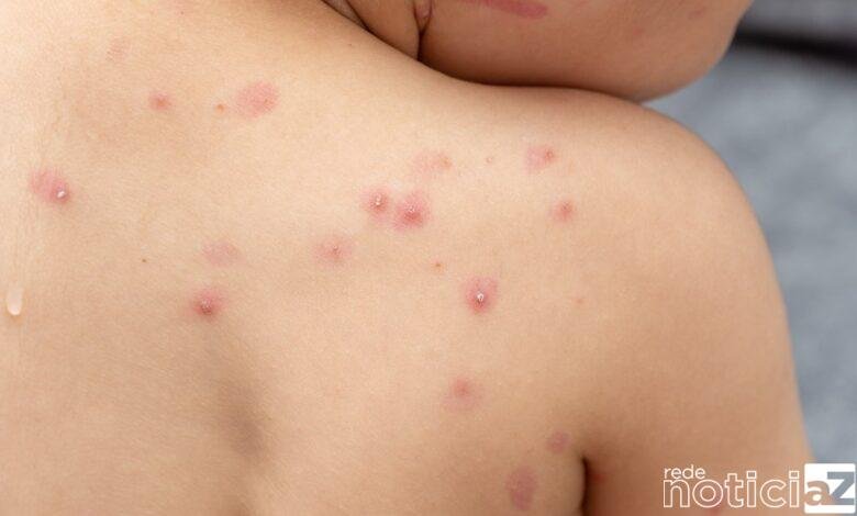 Brasil contabiliza 76 casos de varíola dos macacos, diz Ministério da Saúde