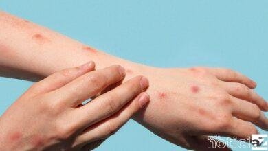 Cabreúva registra o primeiro caso de varíola dos macacos