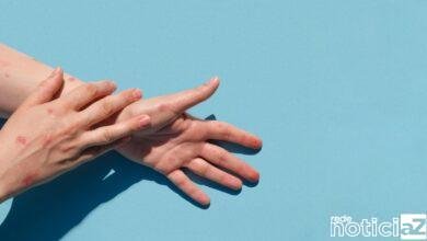 Jundiaí e região já soma 26 casos de varíola dos macacos