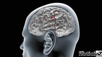 Aneurisma cerebral: por que a doença mata antes de ser diagnosticada?