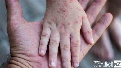 Notificação de casos da varíola dos macacos