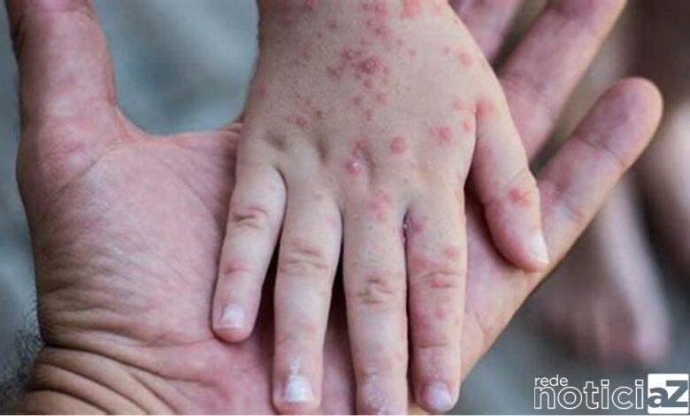 Notificação de casos da varíola dos macacos