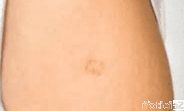 Vacina BCG agora é aplicada apenas com agendamento