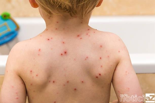 Prefeitura de Jundiaí lembra que o Fim do inverno propicia incidência de catapora