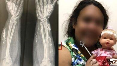 Golpista que fingiu ser adolescente vítima de estupro tinha agulhas pelo corpo