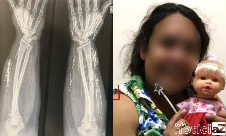 Golpista que fingiu ser adolescente vítima de estupro tinha agulhas pelo corpo
