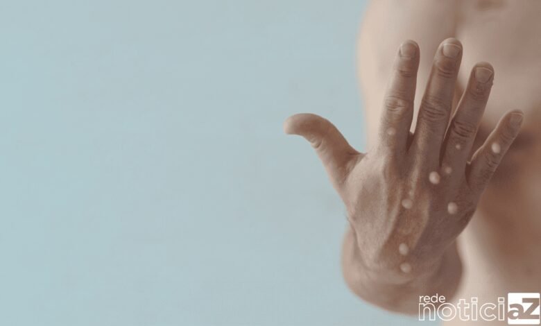 Brasil atinge a marca de 10 mil casos da varíola do macaco