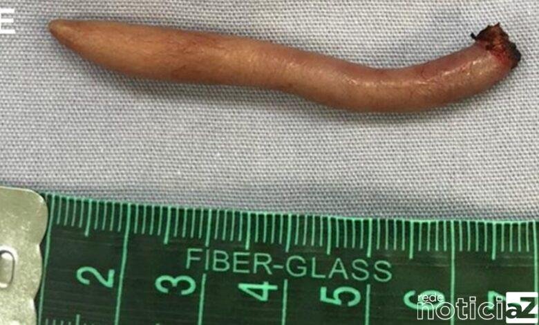 Bebê nasce com uma cauda de 6 centímetros