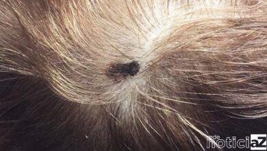 Câncer de pele é mais frequente na cabeça e pescoço