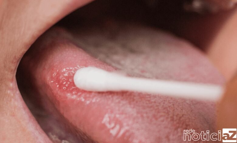 Leucoplasia: Manchas brancas na mucosa da boca devem ser investigadas