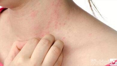 Descubra quais são os sintomas que provocam a alergia na pele