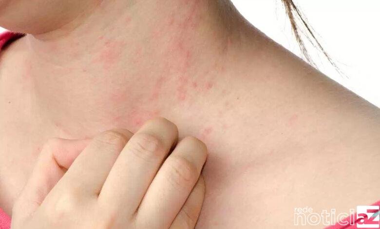 Descubra quais são os sintomas que provocam a alergia na pele